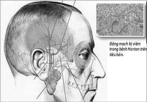 Temporal Arteritis - Ảnh minh họa 1