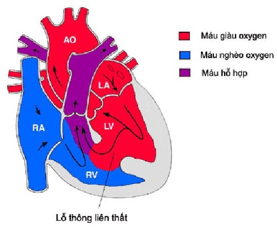 Thông liên thất - Ảnh minh họa 3