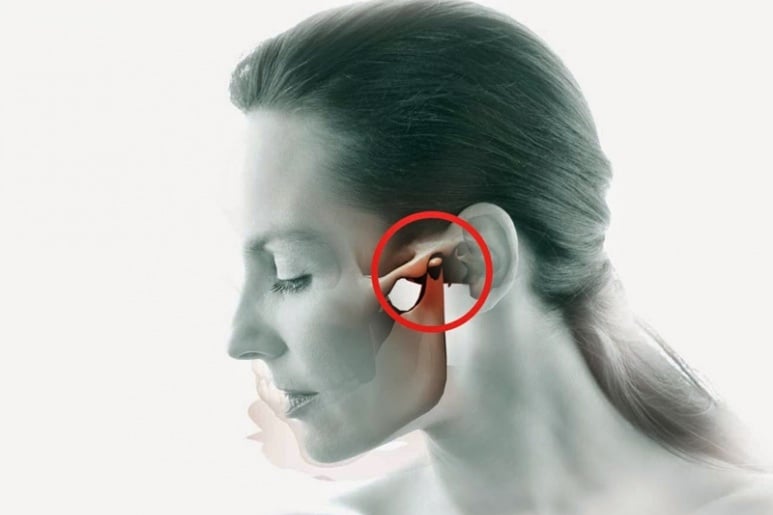 Temporal Arteritis - Ảnh minh họa 3