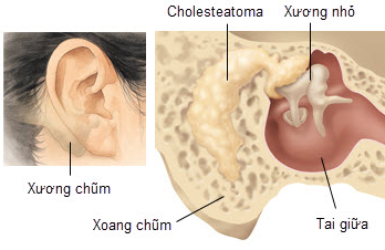 Tympanitis - Ảnh minh họa 2