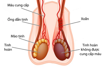 Testicular torsion - Ảnh minh họa 4