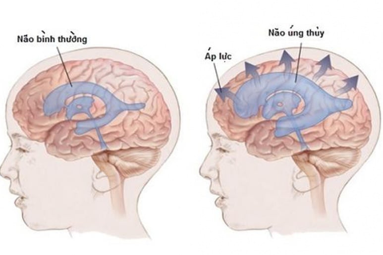 Tràn dịch não - Ảnh minh họa 1