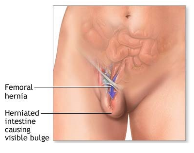 Thoát vị bẹn (Thoát vị háng) - Ảnh minh họa 1
