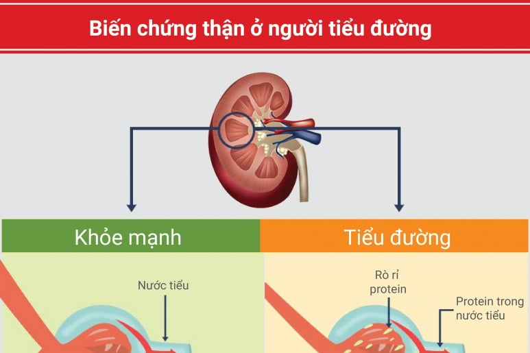 Thận đái tháo đường - Ảnh minh họa 2