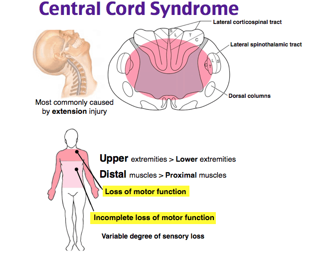 Central Cord Syndrome - Ảnh minh họa 1