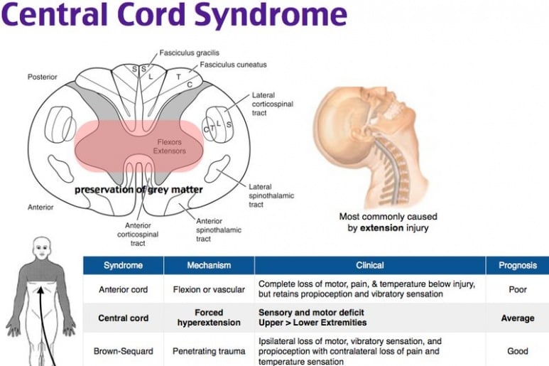 Central Cord Syndrome - Ảnh minh họa 2