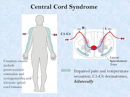 Central Cord Syndrome - Ảnh minh họa 3