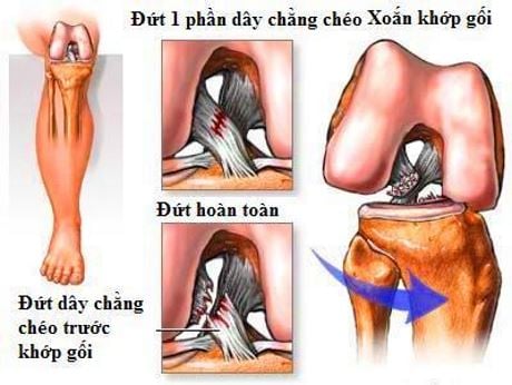 Chấn thương dây chằng chéo trước (Khớp gối) - Ảnh minh họa 4