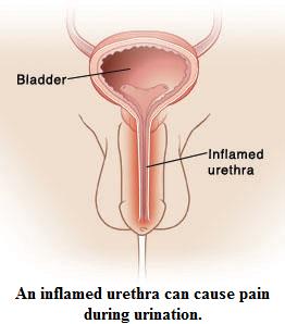 Urethritis - Ảnh minh họa 3