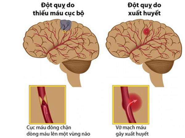 Tắc động mạch tiểu não dưới sau (đột quỵ) - Ảnh minh họa 3