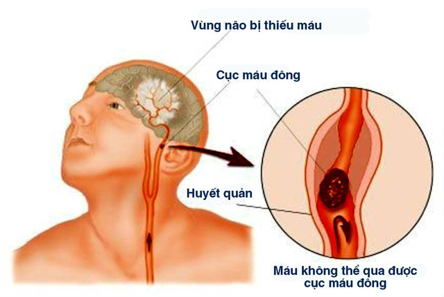 Tắc động mạch tiểu não dưới sau (đột quỵ) - Ảnh minh họa 4