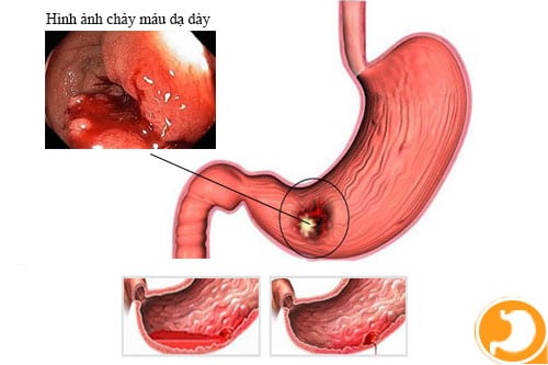 Thủng dạ dày, ruột - Ảnh minh họa 3