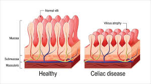 Celiac (Tiêu chảy phân mỡ) - Ảnh minh họa 4