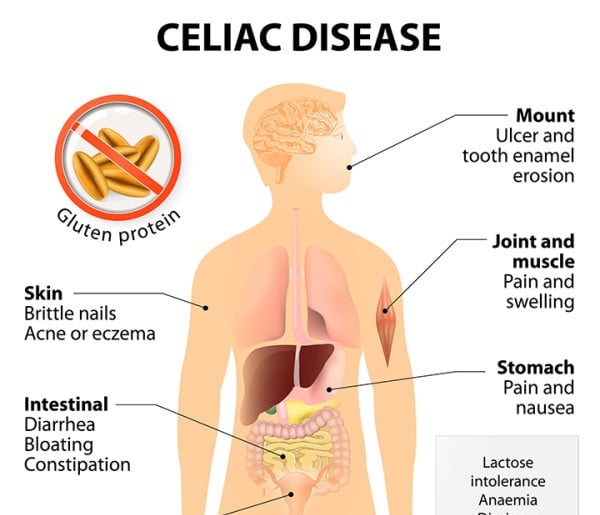 Celiac (Tiêu chảy phân mỡ) - Ảnh minh họa 5