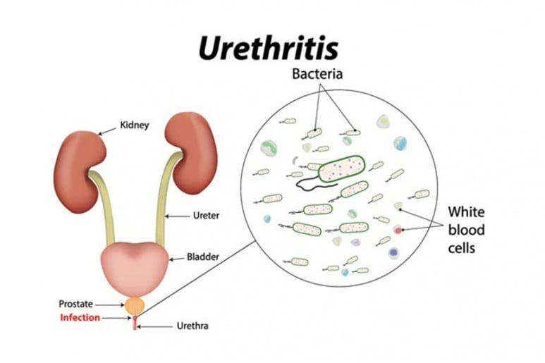 Urethritis - Ảnh minh họa 4