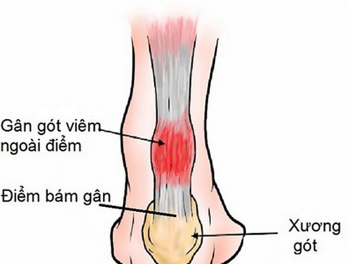 Viêm gân gót chân - Ảnh minh họa 1