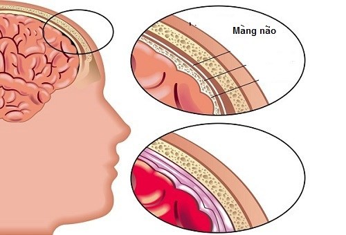 Viêm màng não do Haemophilus - Ảnh minh họa 1