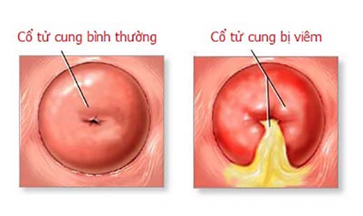 Viêm cổ tử cung - Ảnh minh họa 3