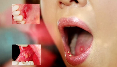 Vết thương thủng ở môi - Ảnh minh họa 2