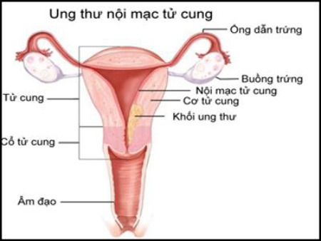 Ung thư nội mạc tử cung - Ảnh minh họa 1