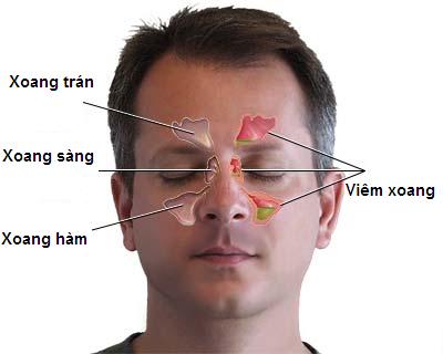 Viêm xoang hàm - Ảnh minh họa 1