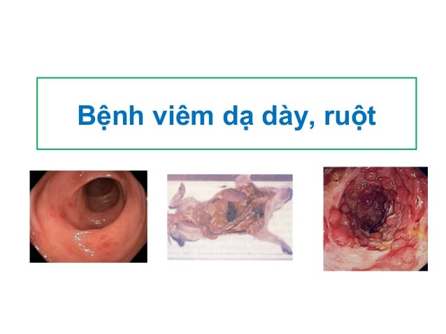 Chảy máu dạ dày, ruột - Ảnh minh họa 3