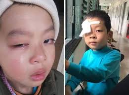 Chấn thương mắt - Ảnh minh họa 2