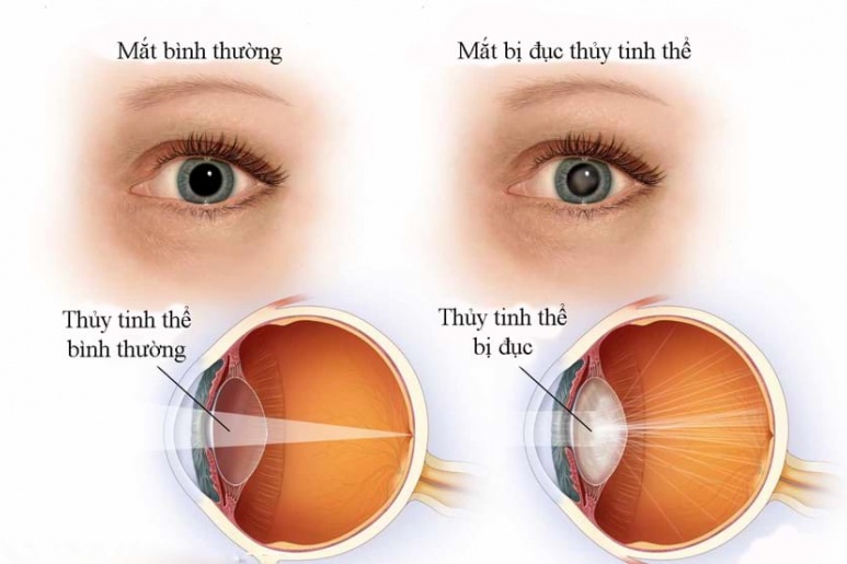 Cườm khô người già - Ảnh minh họa 1