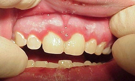 Viêm miệng do virus Herpes - Ảnh minh họa 1