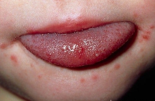 Viêm miệng do virus Herpes - Ảnh minh họa 2