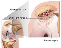 Chondromalacia - Ảnh minh họa 2