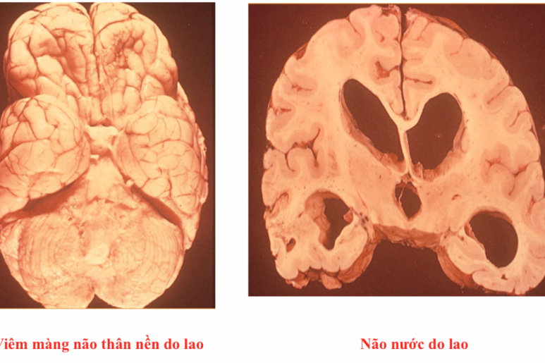 Viêm màng não - Ảnh minh họa 2