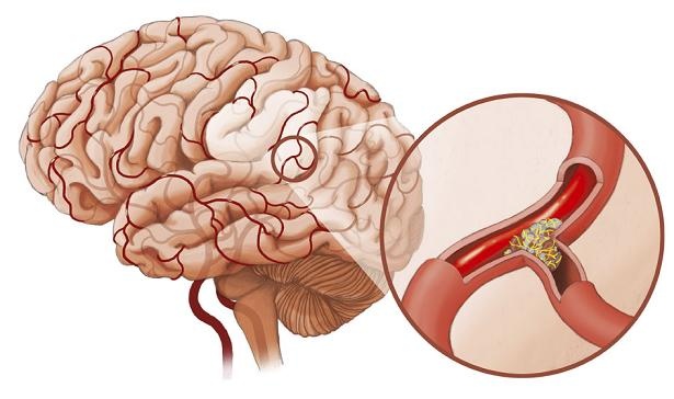 Cerebrovascular accident (CVA) - Ảnh minh họa 1