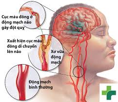 Cerebrovascular accident (CVA) - Ảnh minh họa 2