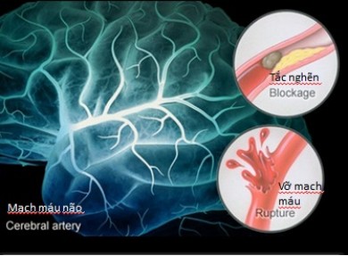 Cerebrovascular accident (CVA) - Ảnh minh họa 3