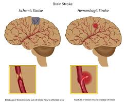 Cerebrovascular accident (CVA) - Ảnh minh họa 4