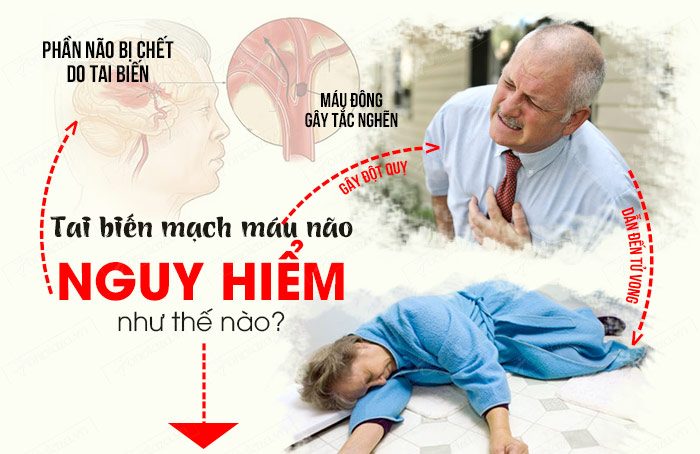 Cerebrovascular accident (CVA) - Ảnh minh họa 5