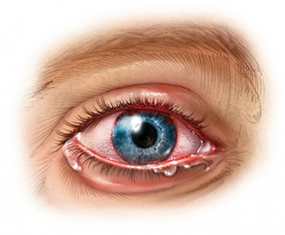 Uveitis - Ảnh minh họa 4