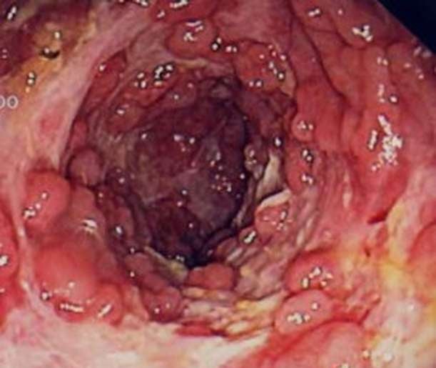 Crohn - Ảnh minh họa 2