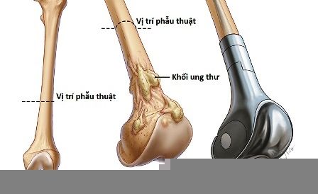 Ung thư xương - Ảnh minh họa 2