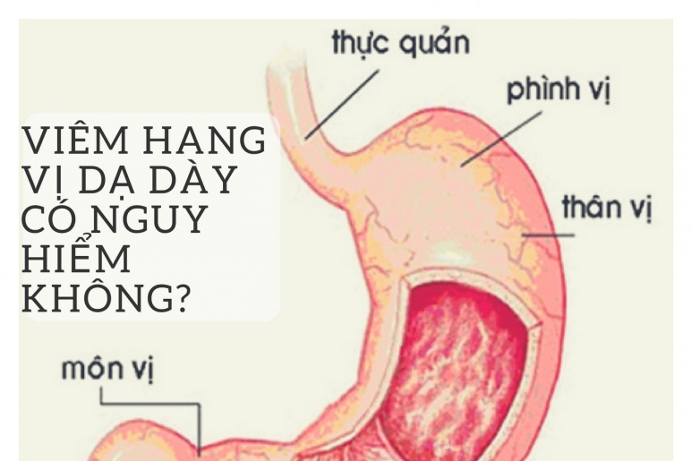 Viêm xung huyết hang vị dạ dày - Ảnh minh họa 1