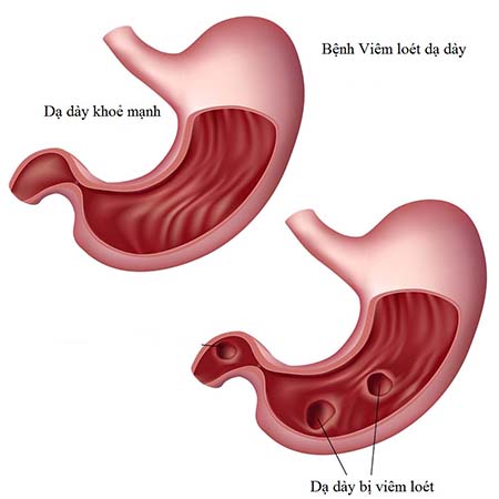 Viêm dạ dày - Ảnh minh họa 3