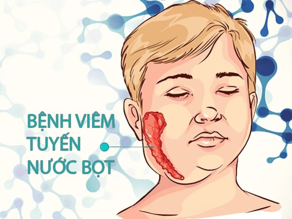 Viêm tuyến nước bọt - Ảnh minh họa 2