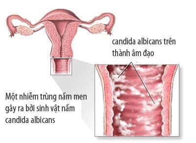 Viêm âm đạo do nấm - Ảnh minh họa 1