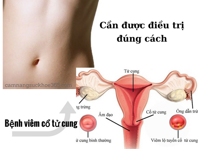 Viêm cổ tử cung - Ảnh minh họa 4