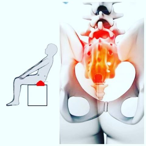 U nang Pilonidal (túi chất lỏng trên xương cụt) - Ảnh minh họa 2