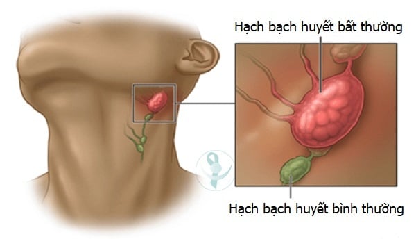 Viêm mô bạch huyết - Ảnh minh họa 1