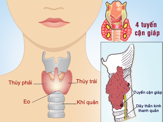 Ung thư tuyến cận giáp - Ảnh minh họa 1