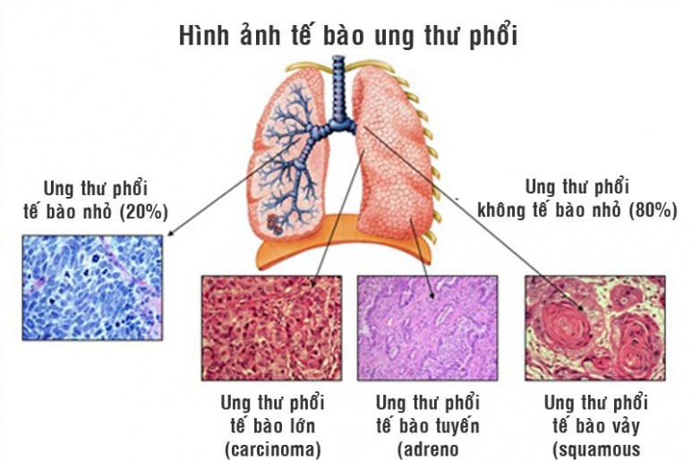 Ung thư phổi tế bào vảy - Ảnh minh họa 1