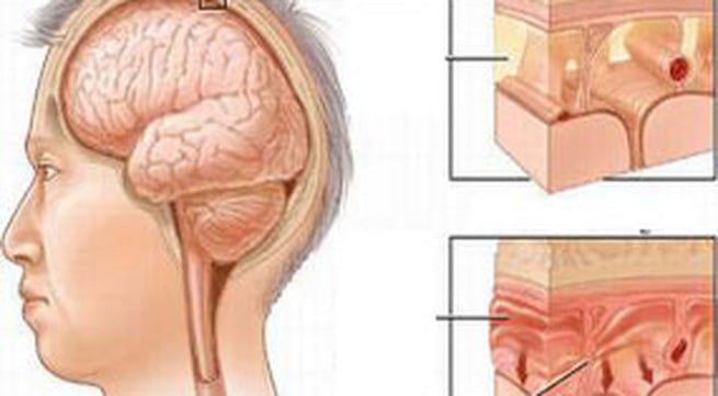 Viêm màng não - Ảnh minh họa 1